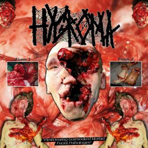 Download track Escape Of Bodily Fluids From Neorectal Scabs HYGROMA