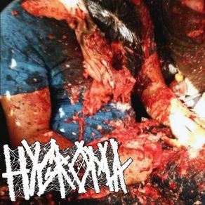 Download track Arterial Tearing By Medical Equipment HYGROMA